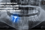 How Dental Implants Are Changing the Dental Industry