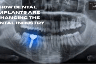 How Dental Implants Are Changing the Dental Industry